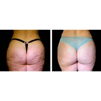 SUPER PROMO 2X1 - BYE BYE CELULITIS